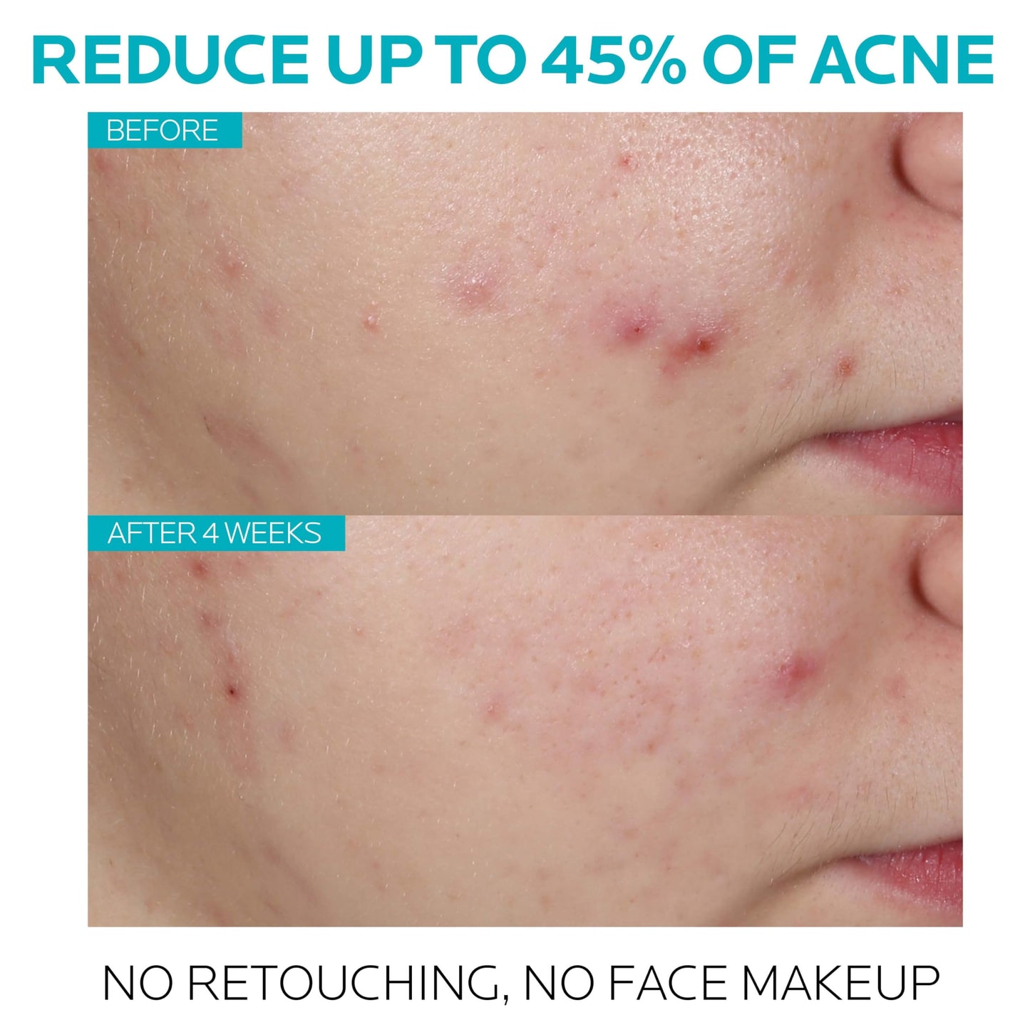 La Roche Posay Effaclar Ultra Concentrated Serum 30ml